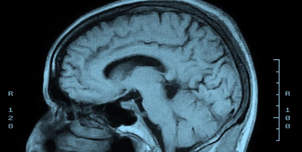 Pourquoi les tumeurs cérébrales sont plus fréquentes chez les ...
