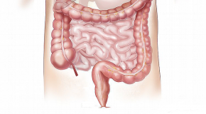 Cancer colorectal, l’importance d’un dépistage précoce cancer colorectal dépistage précoce survie rectum colon test