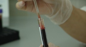 Cancer de la prostate, le dosage du PSA réduit la mortalité cancer prostate dépistage dosage PSA réduction mortalité