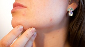 Acné, les origines des boutons rebelles acné bouton adolescence enfant visage adulte homme femme