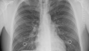 Ionocytes pulmonaires, de l’espoir contre la mucoviscidose Ionocytes pulmonaires mucoviscidose malade poumons autosomique génétique