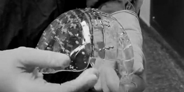 Une quipe mdicale nerlandaise vient d'implanter un crne en plastique  une femme de 22 ans