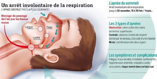 L'implant rduirait de 68 % les symptmes lis  l'apne du sommeil