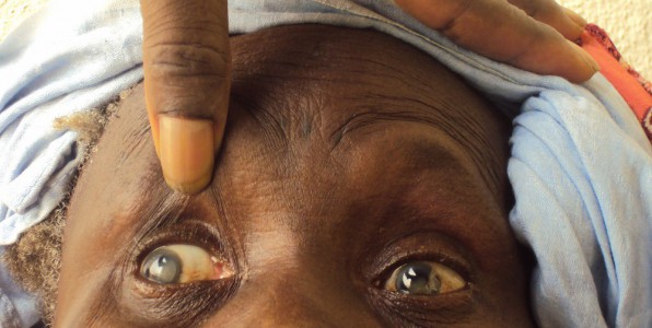 22 millions de personnes souffrent de la cataracte dans le monde