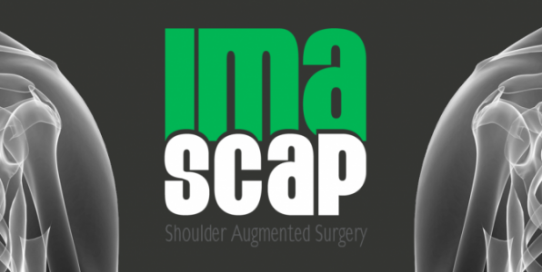 L'arthroplastie de l'épaule améliorée par Imascap Imascap arthroplastie épaule logiciel planification pré-opératoire