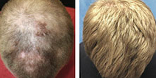 A gauche, une photo pendant le traitement, on observe que les cheveux commencent  repousser. A droite, les cheveux foisonnent aprs quelques mois de traitement. 