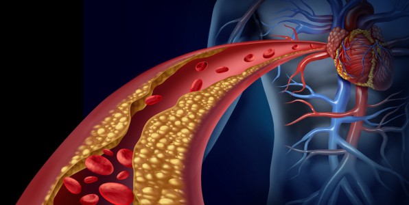 cholestrol vitamine B3 niacine statine maladie cardiovasculaire AVC accident crbral
