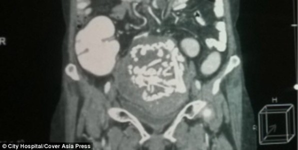 squelette foetus abdomen ventre 36 ans inde 60 ans grossesse extra-uterine