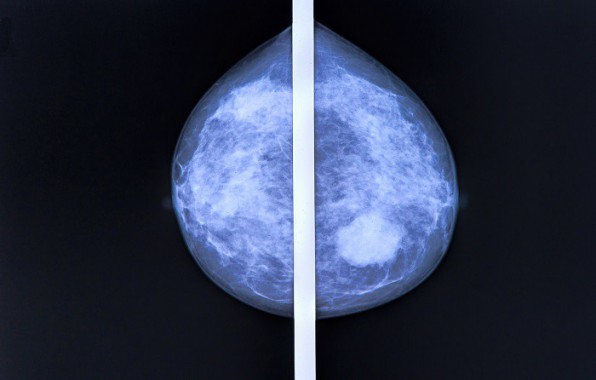 tudes : les mammographies sont-elles indispensables ?