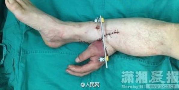 M. Zhou a eu sa main greffe  sa cheville durant 1 mois