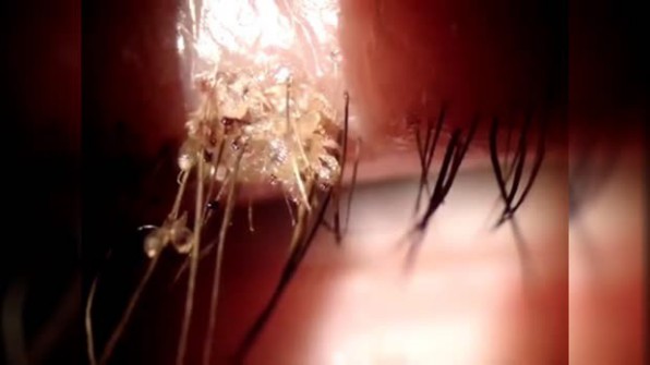 La phtiriase ciliaire : quand les poux se logent sous l'oeil 
