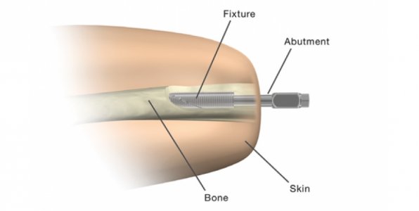 Amputation : une prothèse révolutionnaire fixée à l’os du patient autorisée aux États-Unis Une prothèse à ancrage osseux autorisée aux États-Unis - Crédit : Integrum