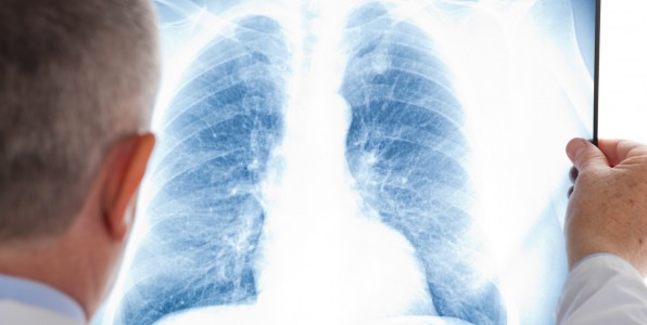 La Mucoviscidose est une maladie qui atteint les poumons