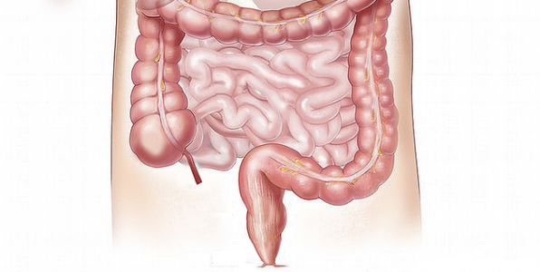 Le cancer colorectal cible le rectum et le colon.