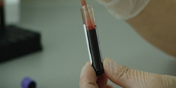 Un nouveau test sanguin permettrait de dtecter certains cancers  un stade prcoce
