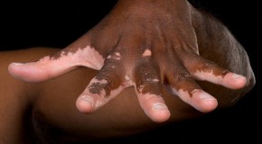Vitiligo maladie cutan�e pathologie probl�me peau d�pigmentation d�coloration pigmentation