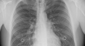 Ionocytes pulmonaires mucoviscidose malade poumons autosomique g�n�tique