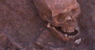 cancer Soudan 3200 ans mtastase lsion origine cancer traitement squelette os