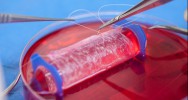 vagins bioartificiels implantation cellules syndrme de Mayer-Rokitansky-Kster-Hauser MRKH dtresse psychologique grossesse cellules musculaires cellules vaginales laboratoire utrus mdecine rgnrative