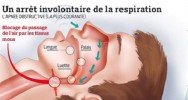 somnolence maladie chronique respiration implant cellule cancreuse diabte langue apne symptome