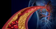 cholestrol vitamine B3 niacine statine maladie cardiovasculaire AVC accident crbral