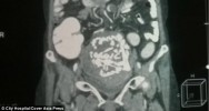 squelette foetus abdomen ventre 36 ans inde 60 ans grossesse extra-uterine