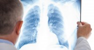 mucoviscidose traitement poumon infection antibiotique greffe don insuffisance respiratoire