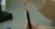 dtection dpistage cancer prise de sang test sanguin