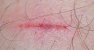 pansement lectris recherche plaie cicatrisation blessure